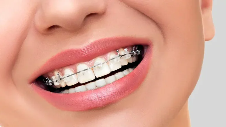 سعر تقويم الاسنان في مصر